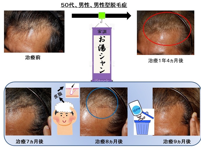 円形脱毛症　病院